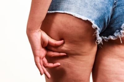cellulite jambes